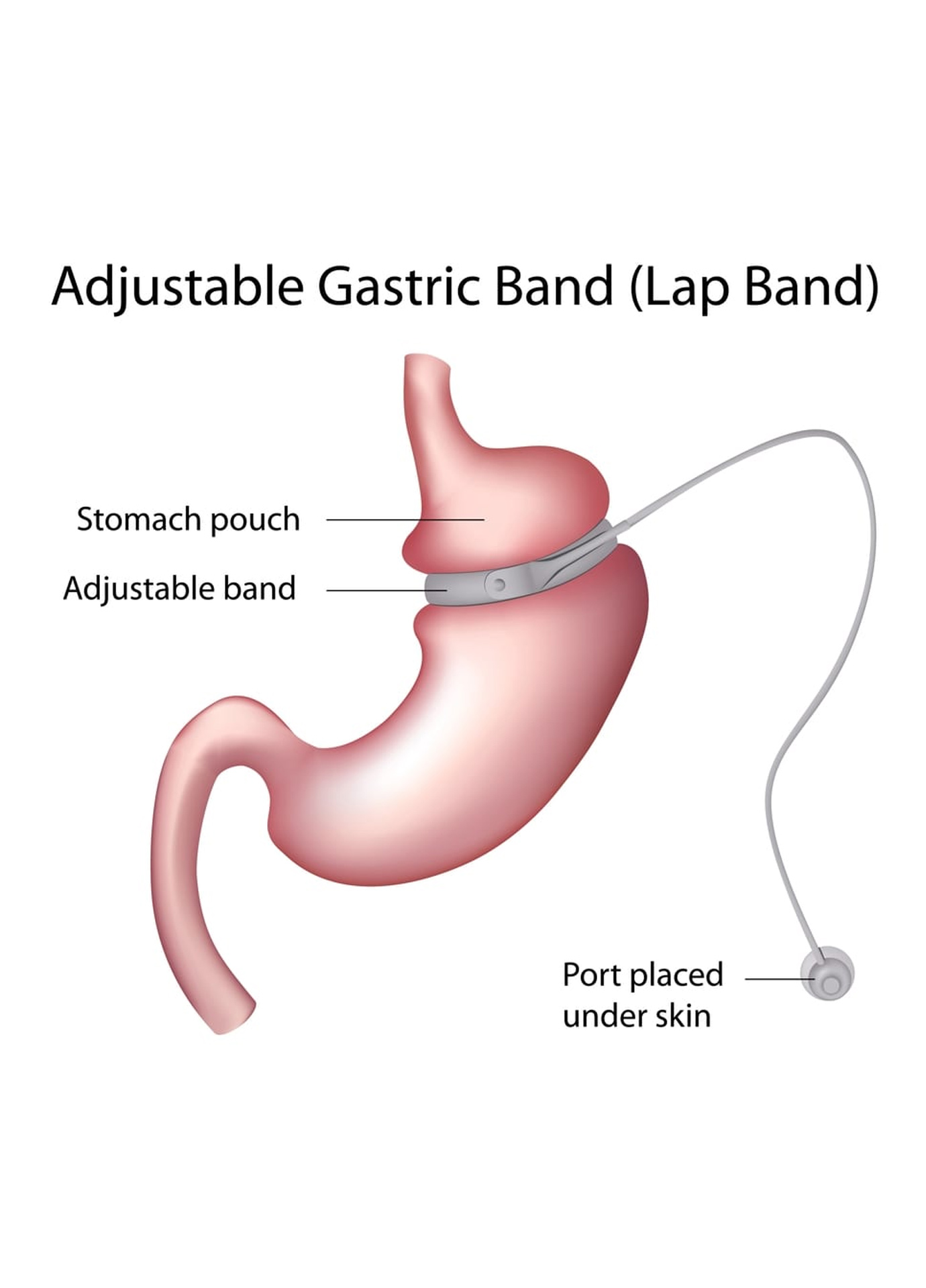 https://nooralmamzar.com/wp-content/uploads/2025/09/gastric-band.jpg