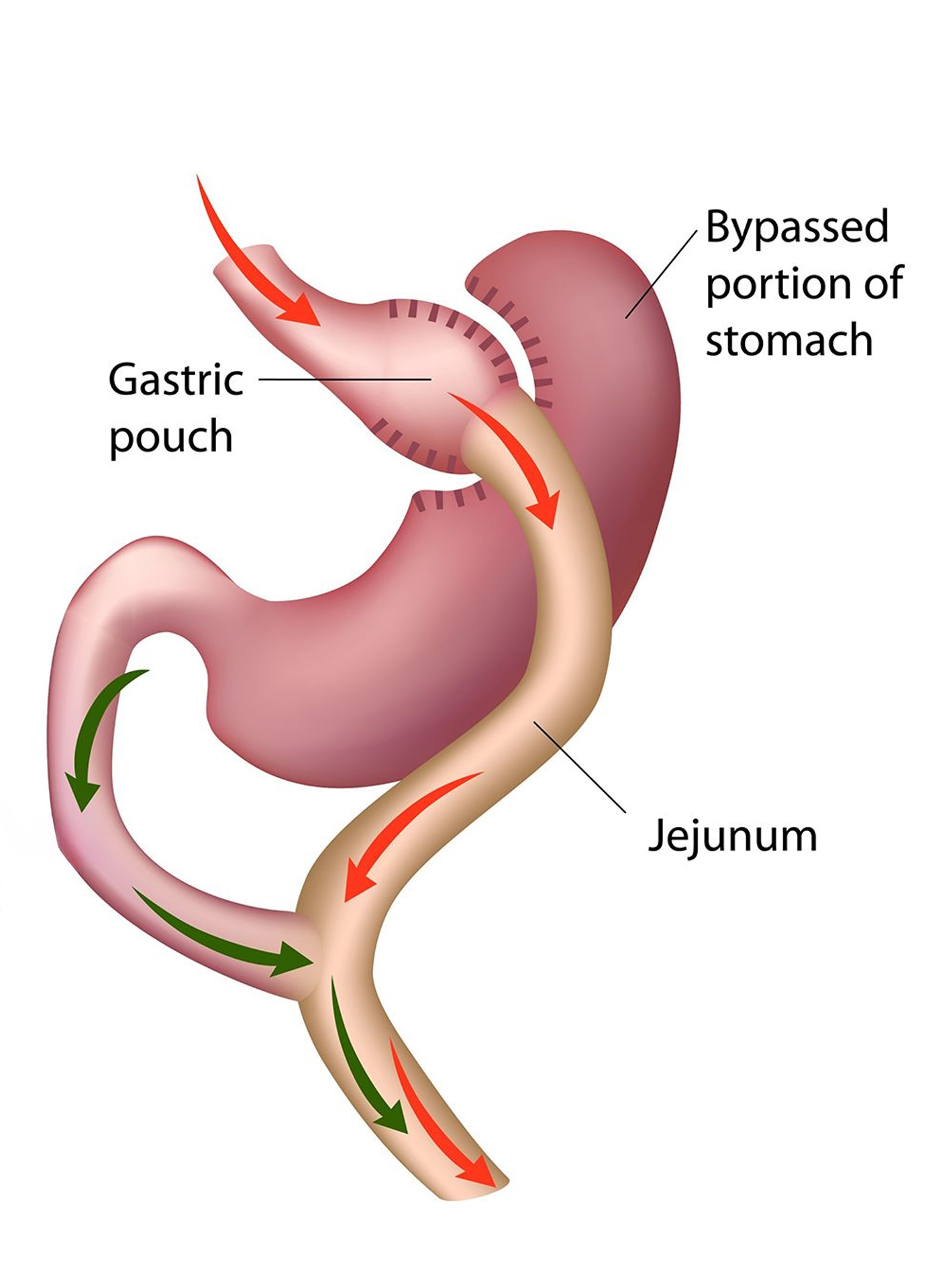 https://nooralmamzar.com/wp-content/uploads/2025/09/gastric-bypass.jpg