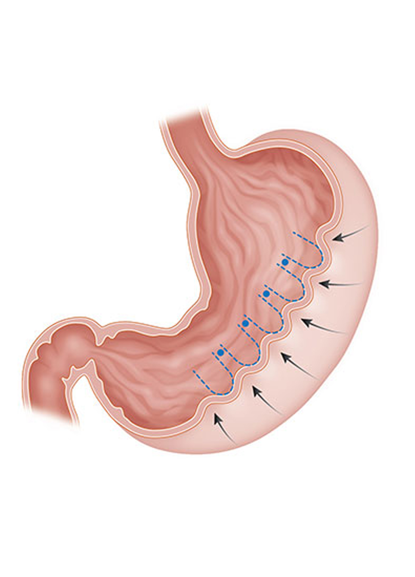 https://nooralmamzar.com/wp-content/uploads/2025/09/gastric-plication.jpg
