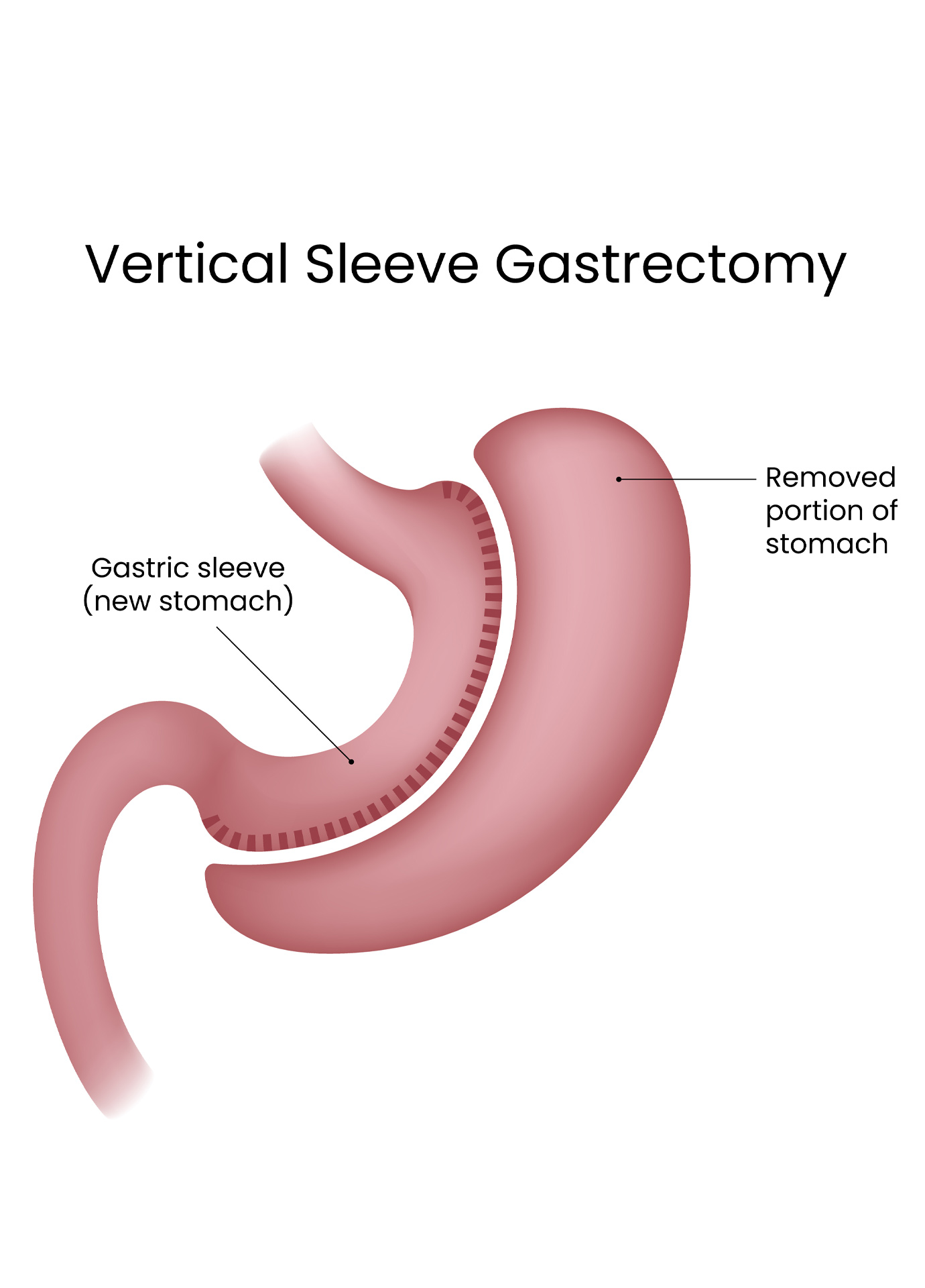 https://nooralmamzar.com/wp-content/uploads/2025/09/gastric-sleeve-01.jpg