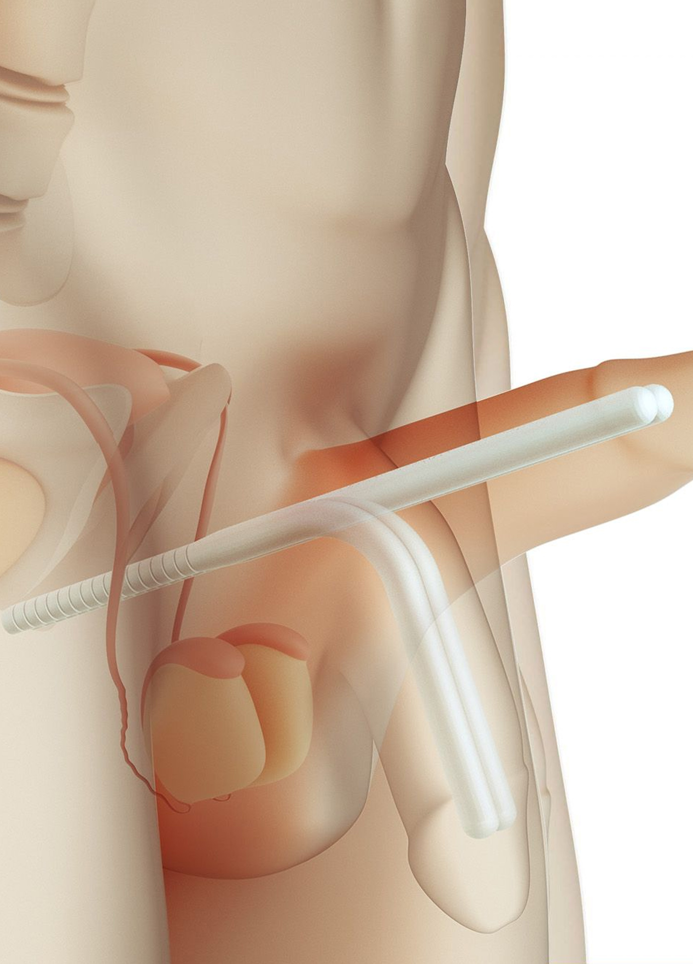 https://nooralmamzar.com/wp-content/uploads/2025/09/malleable-prostheses.jpg