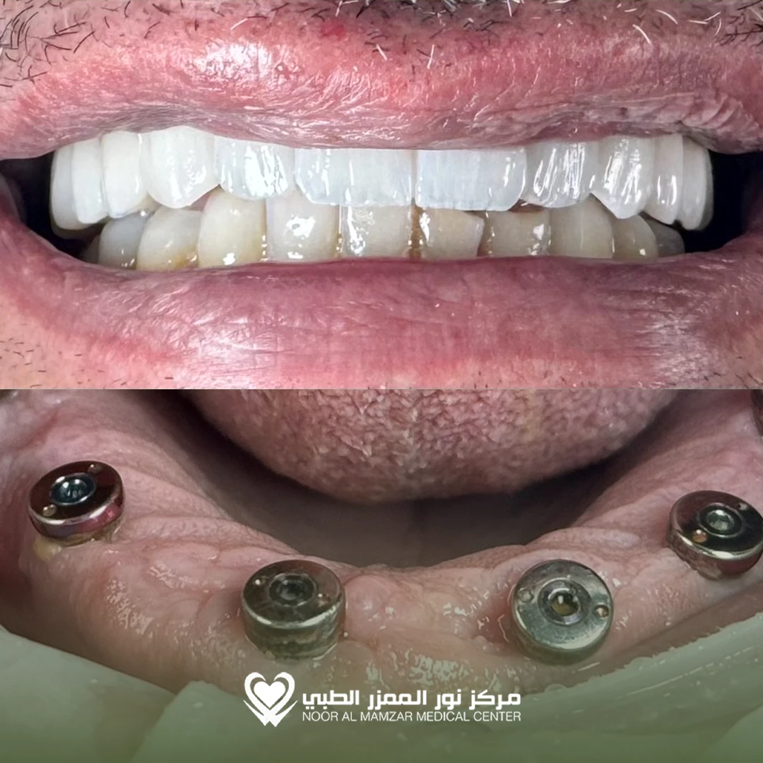Dental before and After 4