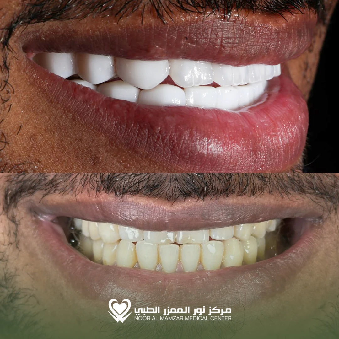 Dental before and After 5