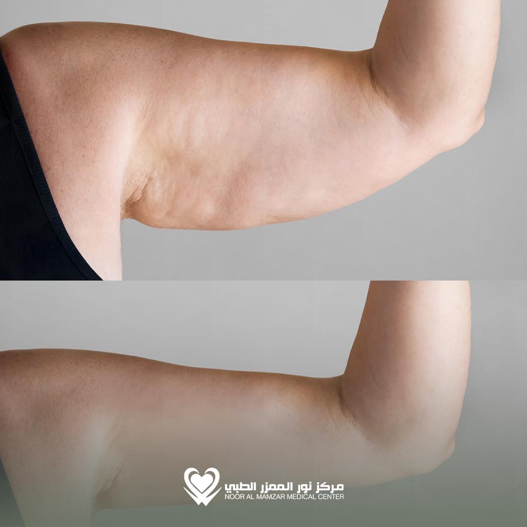 NMMC Before and After 1